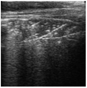 An ultrasound showing lung damage.